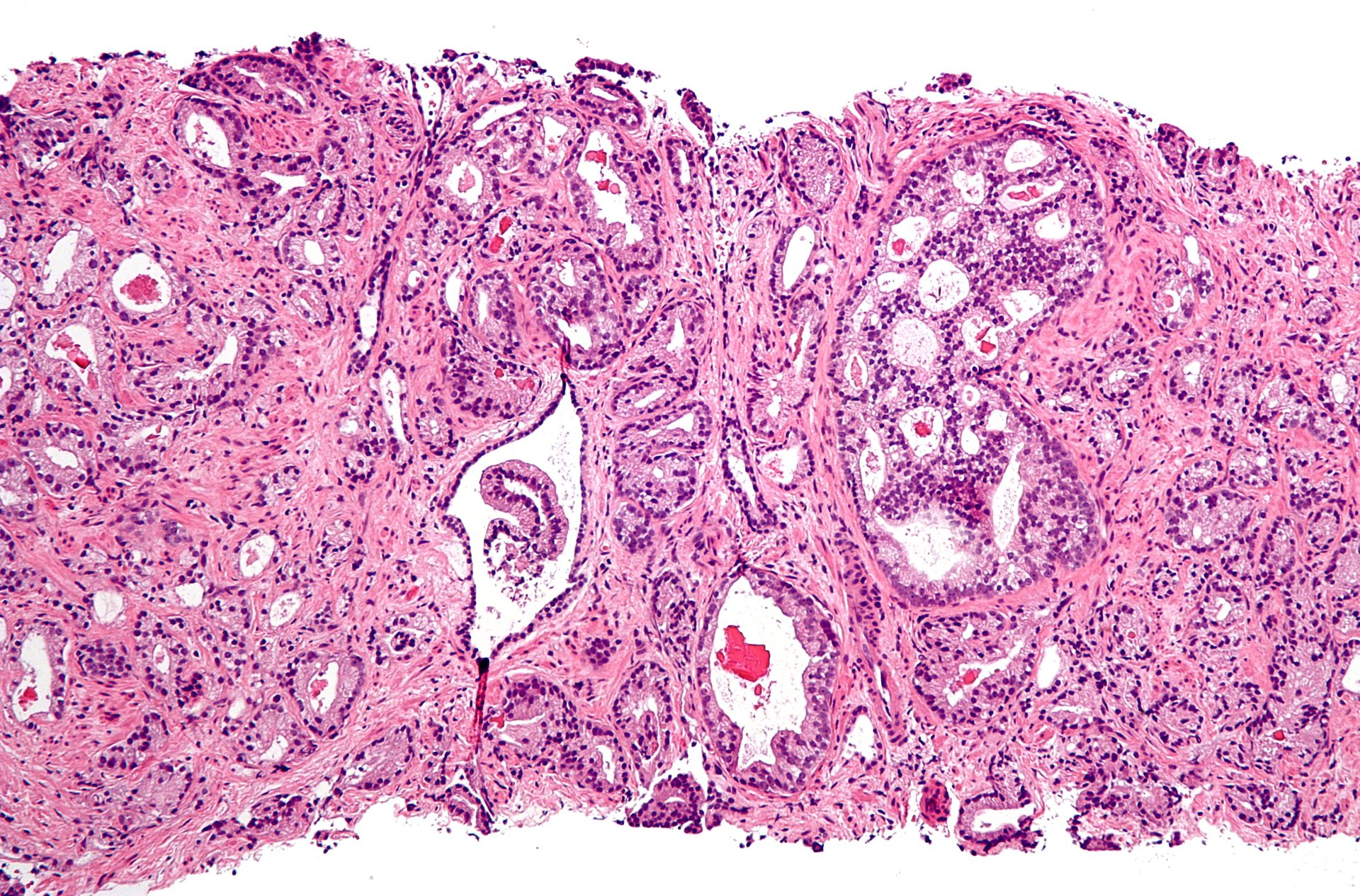 prostate-cancer-tissue-sample-mitosis