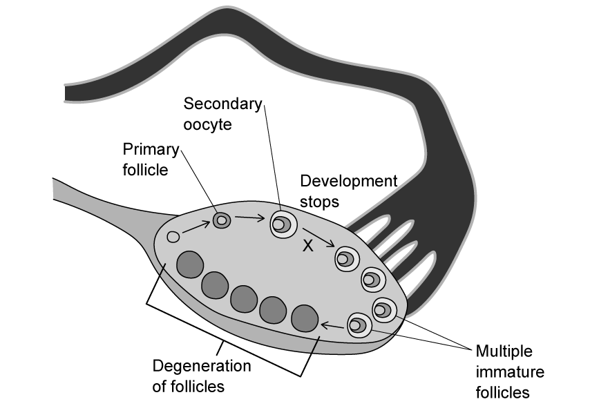 oogenesis-in-pcos-sq